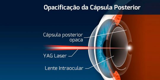 capsulotomia-yag-laser